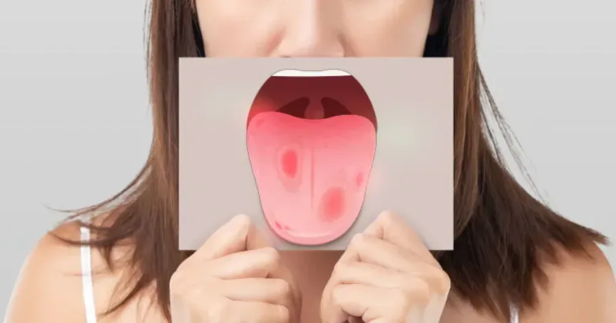 Illusztráció fájdalmas sebekkel a nyelven és a szájüregben.