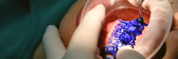 Irányított biofilm-terápia plakk festés